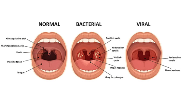 Causes of Tonsil Stones