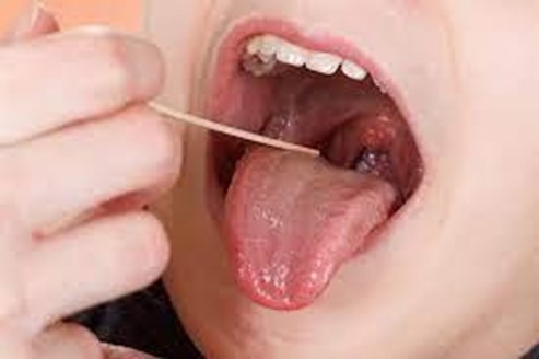 Common Symptoms of Tonsillitis