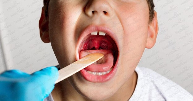 Recovery After Tonsil Surgery in Singapore
