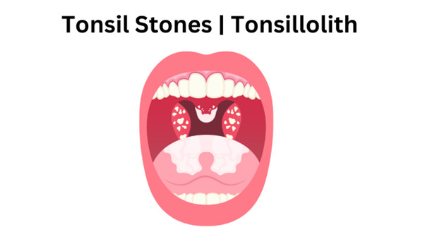 Tonsil Stone Removal Surgery - When You Should See a Tonsillitis Specialist